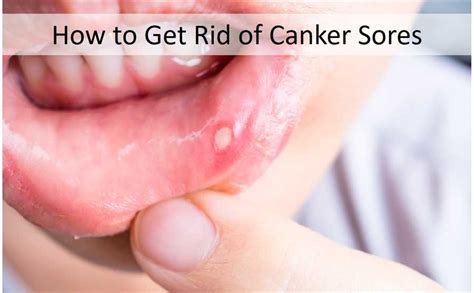 What Causes Canker Sores
