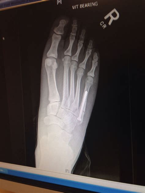 Jones Fracture Jones Fracture Medical Radiography Foot Pain Injury