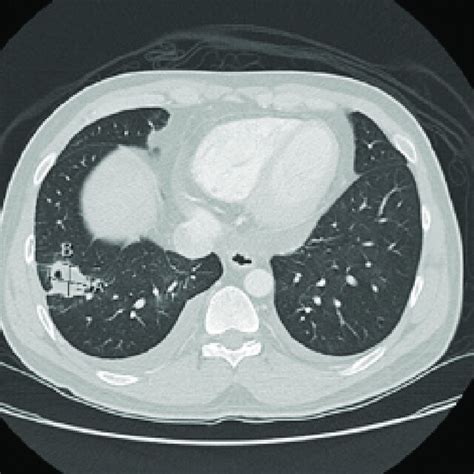 Chest Computed Tomography Scan Revealing A 29 × 23 Cm Pulmonary