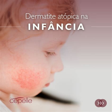 Dermatite Atópica Da Infância Cepelle Dermatologia Curitiba