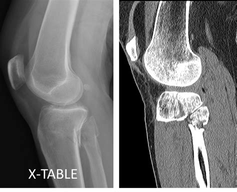 Lateral Tibial Plateau Fracture