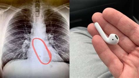 Man Swallows Apple Airpod In Sleep Here S What Happened Next