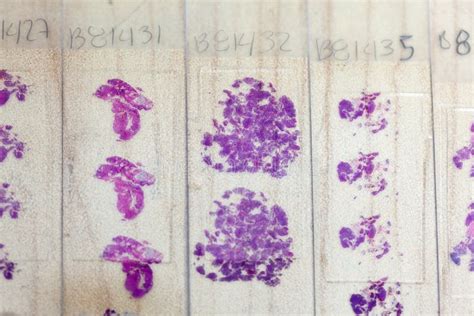 Stained Tissue Biopsy On Glass Slides In Pathology Laboratory Stock