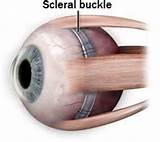 Photos of Scleral Buckle Surgery Recovery