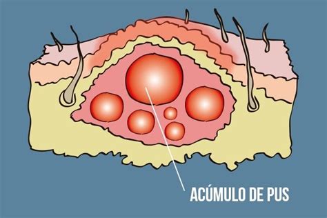 Carbúnculo Porque Surge E Como Tratar Tua Saúde