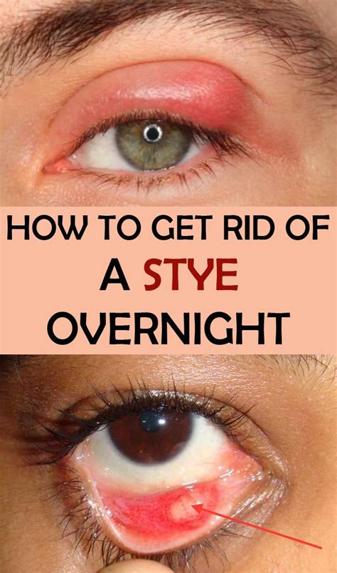 How To Get Rid Of A Stye Overnight Beauty Eye Stye