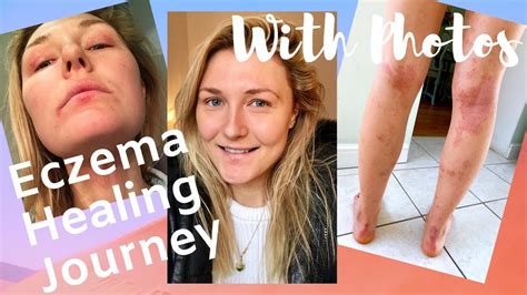 How I Cured My Eczema Naturally My Eczema Journey Heal Eczema