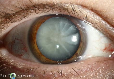 Mature Cortical Cataract