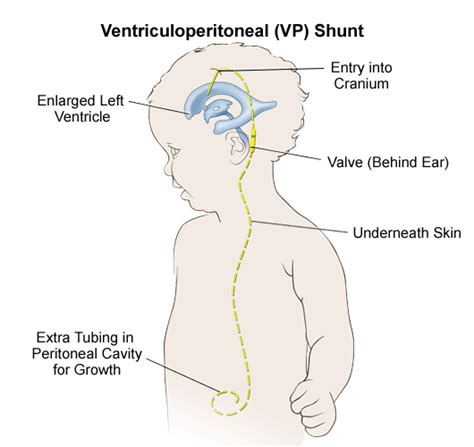 Our Evidence Pediatric Nursing Cerebrospinal Fluid Vp Shunt