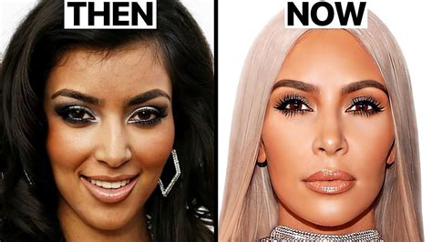 Kim Kardashian S New Face Plastic Surgery Analysis YouTube