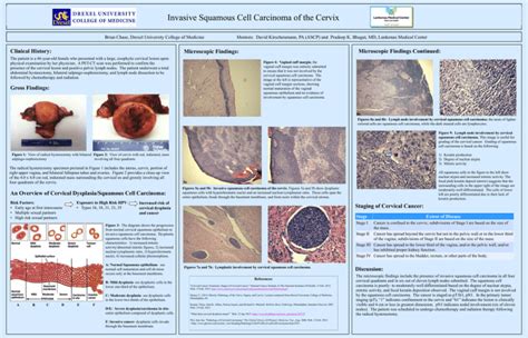 Invasive Squamous Cell Carcinoma Of The Cervix
