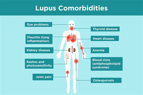 Jan 27, 2021 · lupus is a disease that occurs when your body's immune system attacks your own tissues and organs (autoimmune disease). Lupus Complications: What Lupus Patients Need to Know
