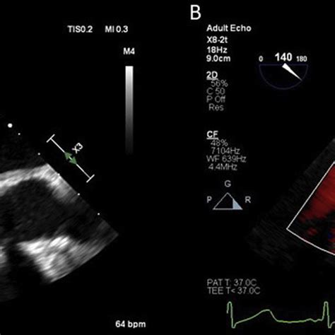 Pdf More Than A Simple Vegetation The Trifecta Of Mitral Valve