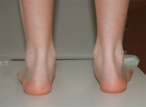 Childrens Heel Pain Ottawa Foot Clinic