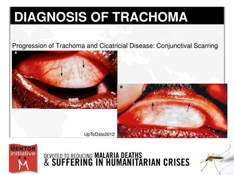 Ppt Trachoma Diagnosis Treatment And Prevention Melina Lopez
