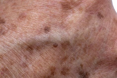 Age Spots On Elderly Skin Stock Image F0302389 Science Photo Library