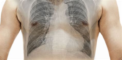 Ich habe aber kein paket erhalten. Asthma und COPD - Wann kommen ICS zum Zug? • doctors|today