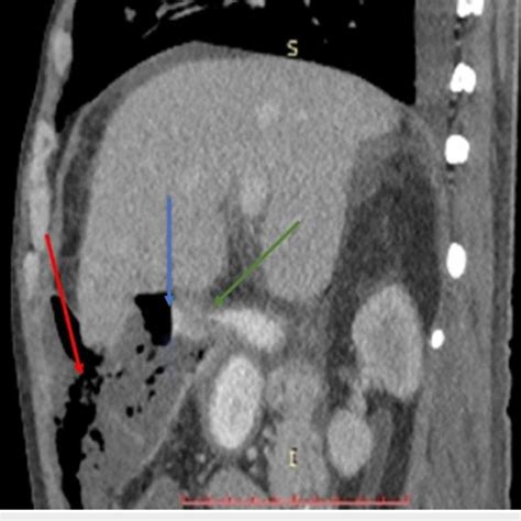 Sagittal Reconstruction Of Contrast Enhanced Ct Of Upper Abdomen