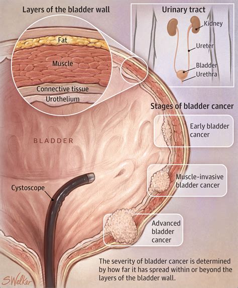 Bladder Cancer Oncology Jama The Jama Network