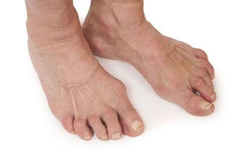 Psoriatic Arthritis Feet Online Discounts Save Jlcatj Gob Mx
