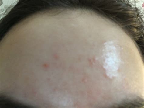Clogged Pores General Acne Discussion