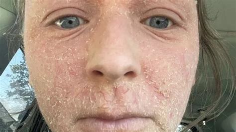 Woman Left Screaming In Agony Due To Withdrawals From Ditching Eczema