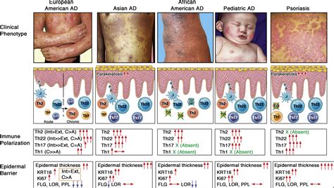 Atopic Dermatitis Endotypes And Implications For Targeted Therapeutics