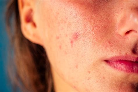A Comprehensive Guide To The Different Types Of Acne Be Beautiful India