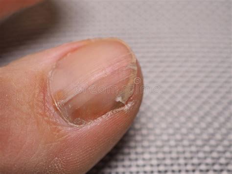 Nail Infections Caused By Fungi Such As Onychomycosis Also Known As