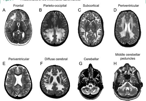 Pdf Invited Article An Mri Based Approach To The Diagnosis Of White
