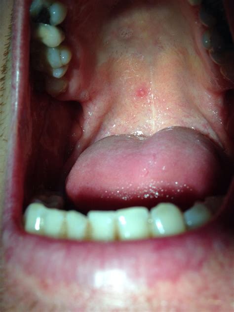Obstruction Of Salivary Duct At The Palate Of The Mouth Mild