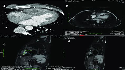 A Computed Tomography Shows Right Ventricular Myxoma That Is