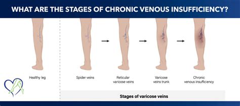 What Are The Stages Of Chronic Venous Insufficiency