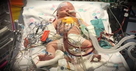 Doctors Stopped This Miracle Babys Heart For 15 Hours During Surgery