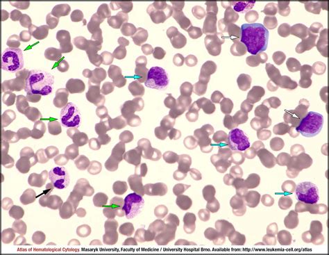 Lymphoid Neoplasm With Eosinophilia And With Fgfr1 Rearrangement