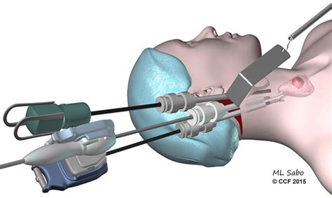 Near Infrared Fluorescence In Robotic Thyroidectomy Muraveika Gland