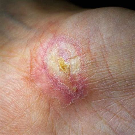 Cellulitis Everything You Need To Know About This Skin Infection