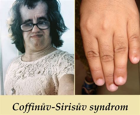 Coffinův Sirisův Syndrom Příznaky Projevy Symptomy Příčina Léčba