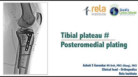 Posteromedial Tibial Plateau Fixation Youtube