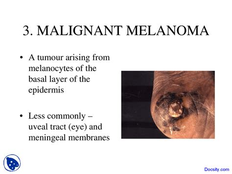 Malignant Melanoma Dermatology Lecture Slides Docsity