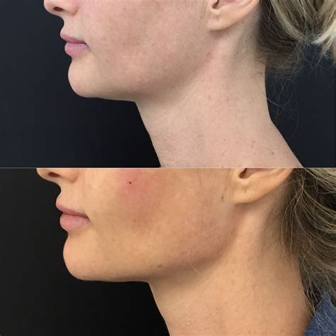 Jawline Filler Package Specials Jaw Fillers And Jawline Chin Fillers