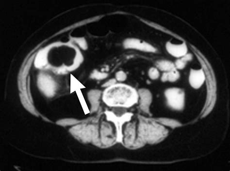 Imaging And Findings Of Lipomas Of The Gastrointestinal Tract Ajr