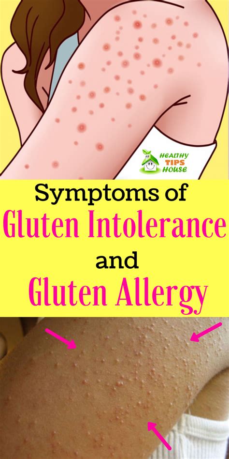 Learn About The Signs Of Gluten Intolerance And How To Treat It