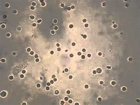 Leucocitos Y Eritrocitos En Orina Doovi