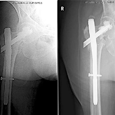 73f Who Sustained An Aoota 31 A1 Fracture Which Was Fixed With A