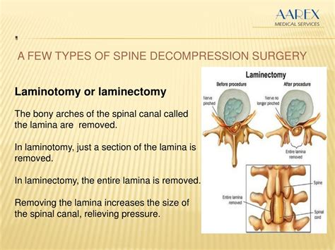 Ppt Spine Decompression Surgery Powerpoint Presentation Free