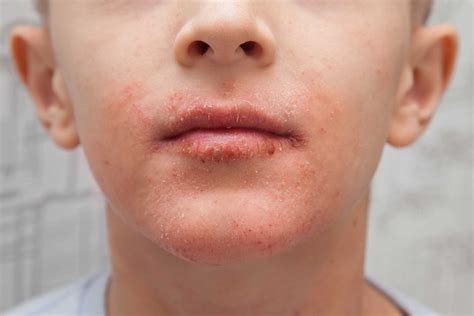 Mouth Rash Could Be Perioral Dermatitis Amazing Smiles