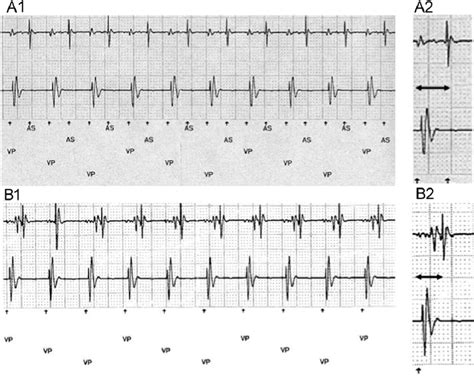 A 1 Pacemaker Telemetry Data During Endless Loop Tachycardia B 1