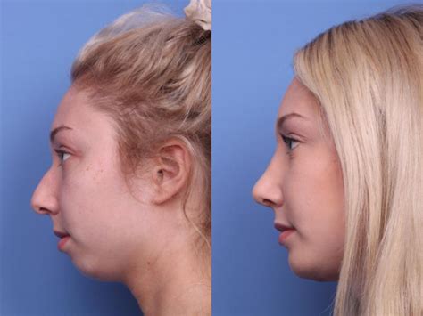 Rhinoplasty Before And After Pictures Case 126 Scottsdale Az