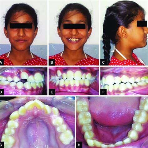 A To H Posttreatment Images A Extraoral Front View B Extraoral